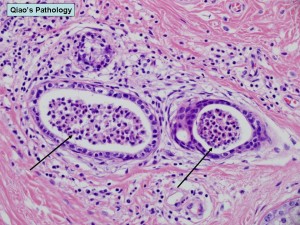 Microscopic photo showing apocrinitis and secondary involvement of eccrine glands with intraluminal microabscess formation (black arrows). Jian-Hua Qiao, MD, FCAP, Los Angeles, CA, USA. Image from FlickRiver.com